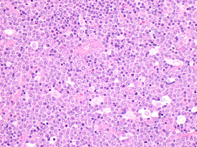 Lymph node biopsy shows the the lymph node is extensively infiltrated by lymphoblastic lymphoma. Scattered eosinophils are present (H&E, 400x).